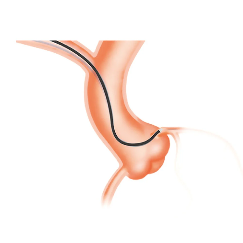 Проводниковый катетер Xcess